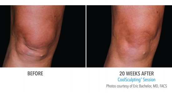 CoolSculpting Knees Before and After Photo