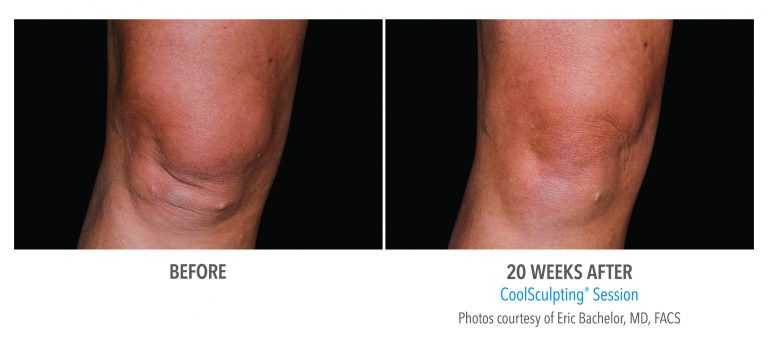 CoolSculpting Knees Before and After Photos