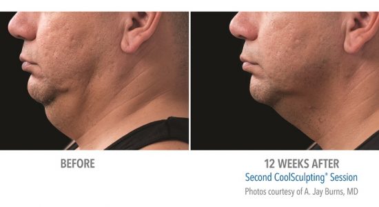 CoolSculpting Double Chin Man Before and After Photos