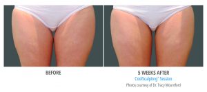 CoolSculpting Thighs Before and After Photos