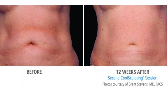 CoolSculpting Belly Fat Before and After Photos