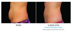 CoolSculpting Belly Before and After Photos