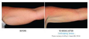 CoolSculpting Arms Before and After Photos