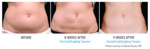 Coolsculpting Session Images Before and After 1