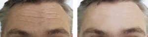 Botox Before and After Botox Forehead Wrinkles