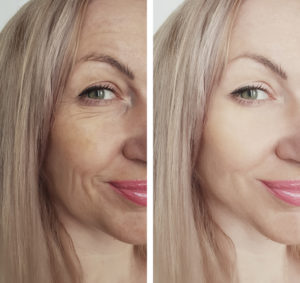 Botox Woodbridge, Botox Vaughan: Botox injection for face of a woman before and after photo