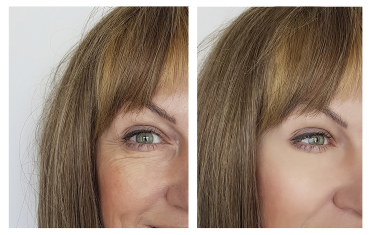 Botox Woodbridge, Botox Vaughan: Botox for crow's feet of a woman before and after