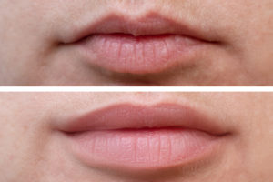 Lip Fillers, Lip Injections, Lip Augmentation Result Woodbridge, Vaughan, Toronto