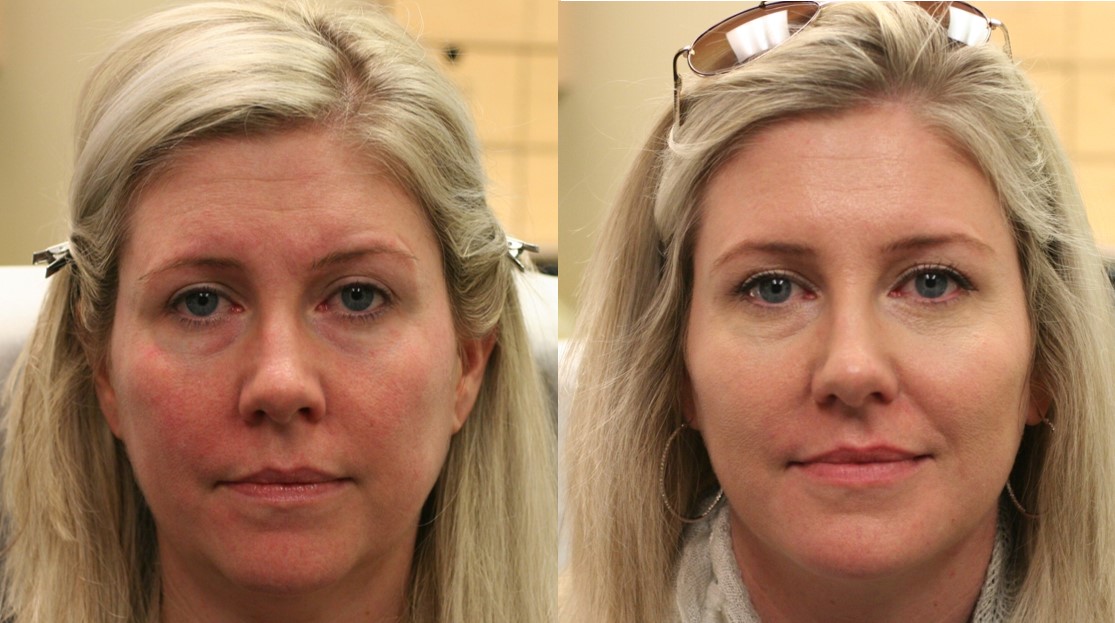 Filler Results | Before and After | Woodbridge Vaughan